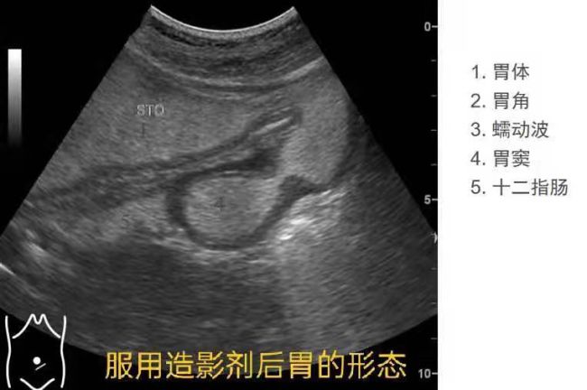 胃,你好吗?——信阳市中心医院成功开展胃超声造影技术