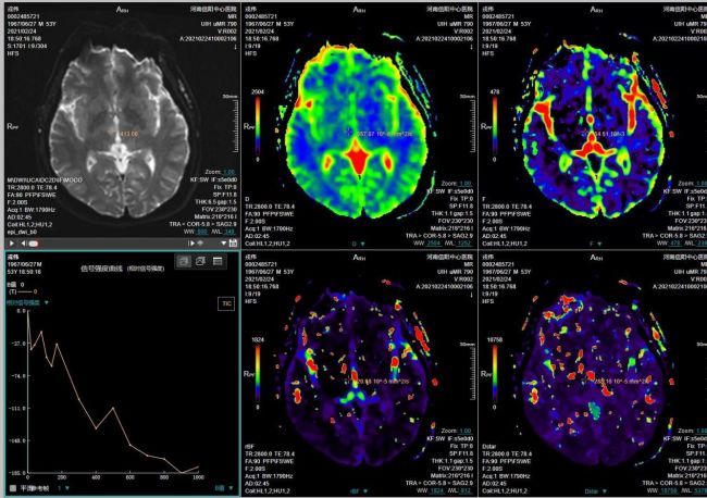 不到3分钟就能完成颅脑磁共振扫描