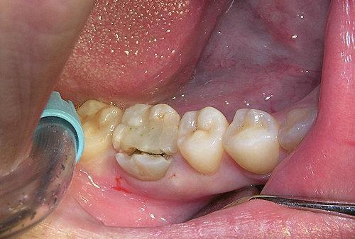 科普信阳市中心医院口腔科专家带您了解牙齿根管治疗后做冠修复的重要